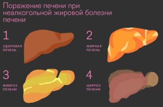 Гепатоз: Причини, Симптоми та Методи Лікування Печінки