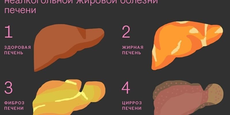 Гепатоз: Причини, Симптоми та Методи Лікування Печінки Гепатоз: Причини, Симптоми та Методи Лікування Печінки