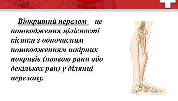 Переломи: Види, Причини та Лікування для Повного Відновлення