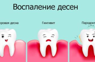Гінгівіт: причини, симптоми та методи лікування захворювання ясен