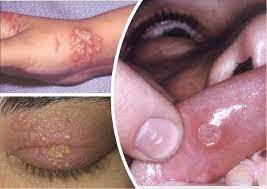 Що таке герпес: все про симптоми, причини та способи лікування