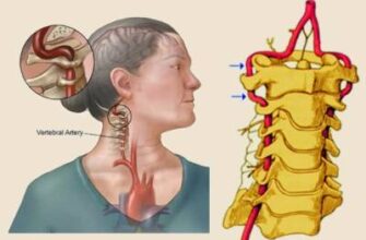 Гіпоплазія правої хребцевої артерії: визначення, симптоми та наслідки