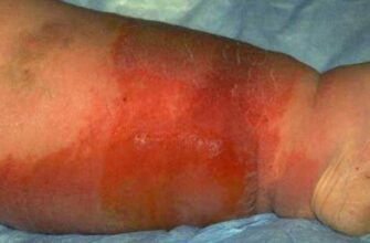 Що таке рожа: симптоми, причини та методи лікування захворювання