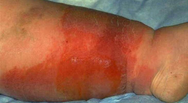 Що таке рожа: симптоми, причини та методи лікування захворювання