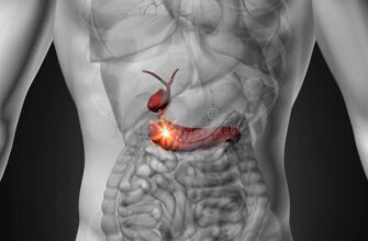 Що таке перитоніт: причини, симптоми та методи лікування захворювання