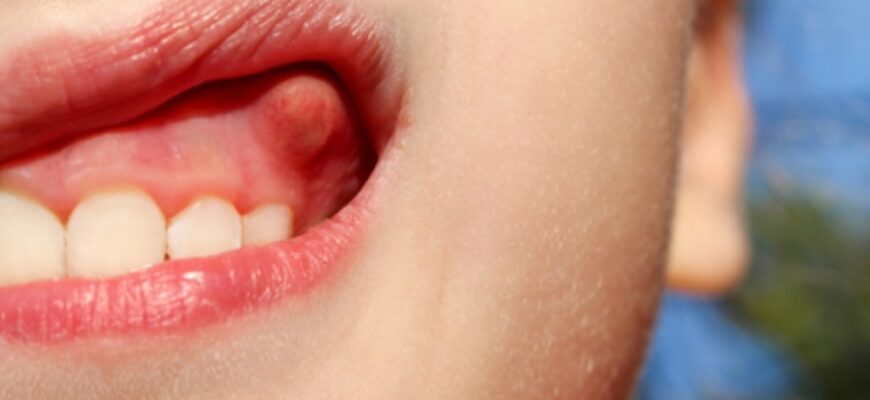 Зрозумійте, що таке свищ: причини, симптоми та лікування ефективно