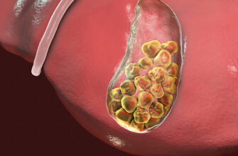 Що таке холецистит: причини, симптоми та методи лікування захворювання