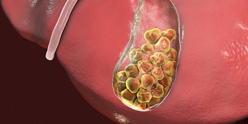 Що таке холецистит: причини, симптоми та методи лікування захворювання
