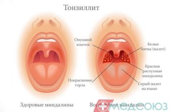 Тонзиліт: Причини, Симптоми та Ефективні Методи Лікування Хвороби