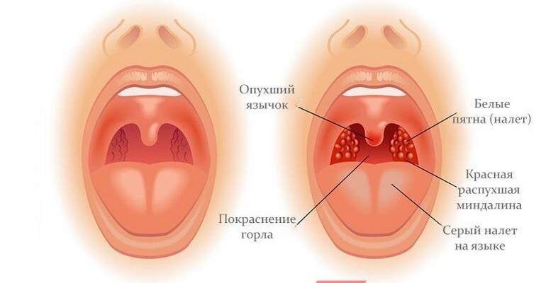 Тонзиліт: Причини, Симптоми та Ефективні Методи Лікування Хвороби