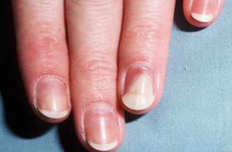 Все, що потрібно знати про оніхолізис: причини, симптоми та лікування