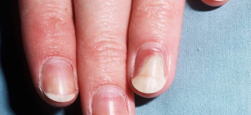 Все, що потрібно знати про оніхолізис: причини, симптоми та лікування