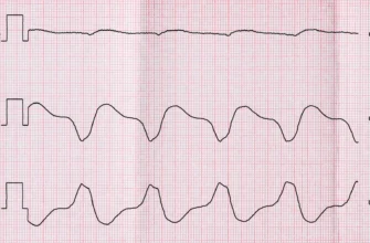 Що таке тахікардія серця: симптоми, причини та методи лікування