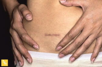 Спайки після операції: причини утворення та їх лікування