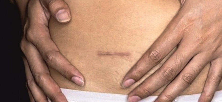 Спайки після операції: причини утворення та їх лікування