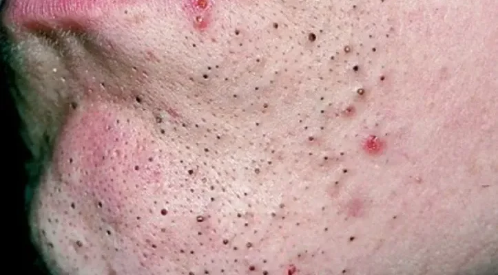 Що таке акне: Причини, симптоми та фотоприклади лікування.