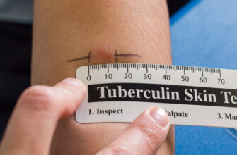 Манту: Що Це Таке, Як Проводять та Які Є Протипоказання