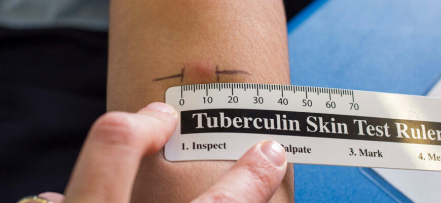 Манту: Що Це Таке, Як Проводять та Які Є Протипоказання