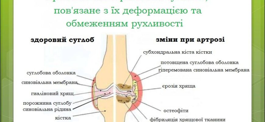Що таке артрит: причини, симптоми та методи ефективного лікування