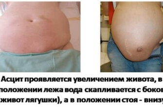 Що таке асцит: причини, симптоми та методи лікування захворювання