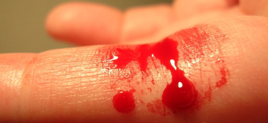 Що таке кровотеча: розуміння причин, видів та методів лікування