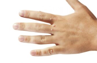 Що таке ліпома: причини, симптоми та методи лікування жировиків