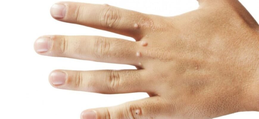 Що таке ліпома: причини, симптоми та методи лікування жировиків