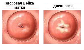 Дисплазія шийки матки: що це таке, причини та методи лікування