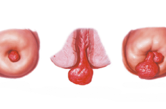 Поліпи: що це таке, причини виникнення та методи лікування