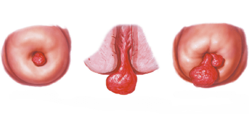 Поліпи: що це таке, причини виникнення та методи лікування