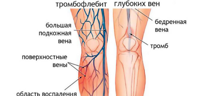 Що таке тромбофлебіт: симптоми, причини та методи лікування