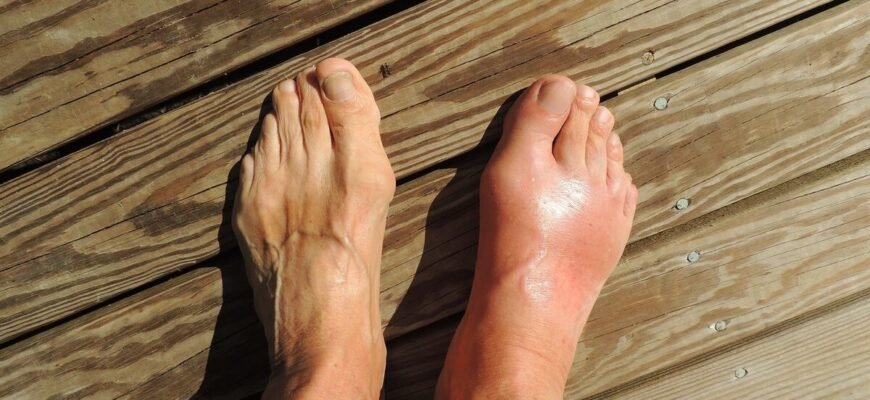 Подагра: що це таке та як її розпізнати? Фото і пояснення.