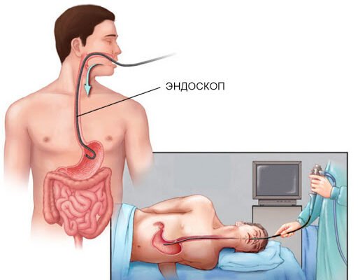 Гастроскопія: що це таке, як проводять та для чого потрібна процедура