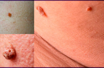 Фіброз: Причини, Симптоми та Лікування Захворювання в Деталях