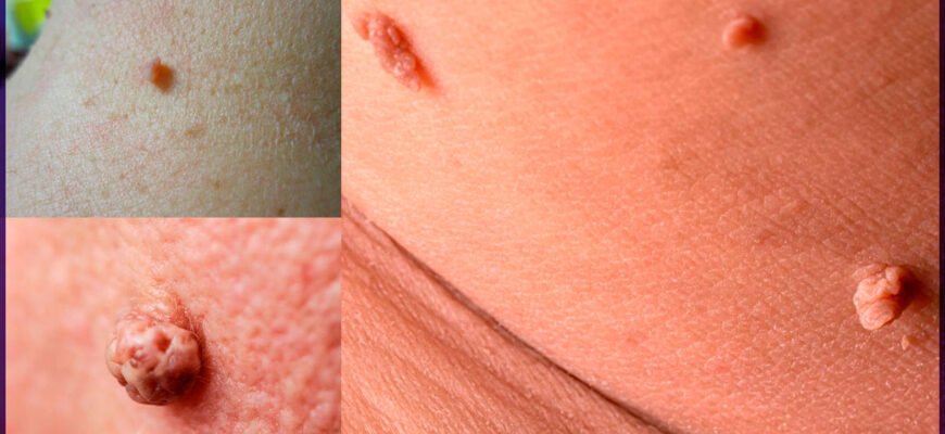 Фіброз: Причини, Симптоми та Лікування Захворювання в Деталях