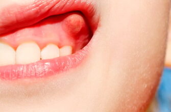 Що таке флюс: причини, симптоми та методи лікування проблеми