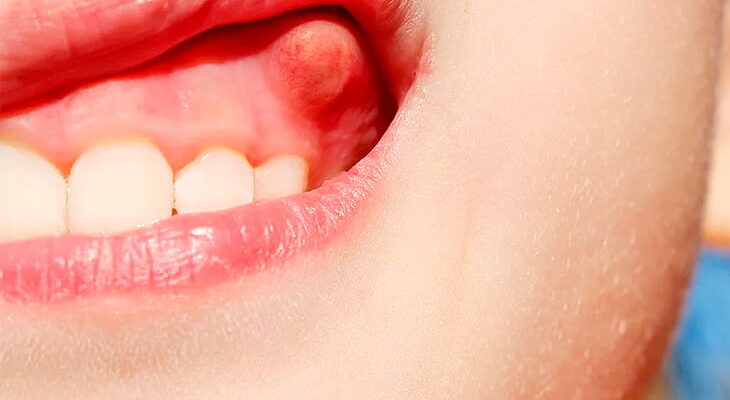 Що таке флюс: причини, симптоми та методи лікування проблеми