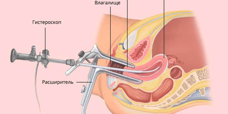 Гістероскопія: сучасний метод діагностики та лікування жіночих захворювань