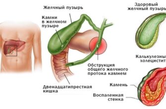 Що таке хронічний холецистит: симптоми, причини та лікування