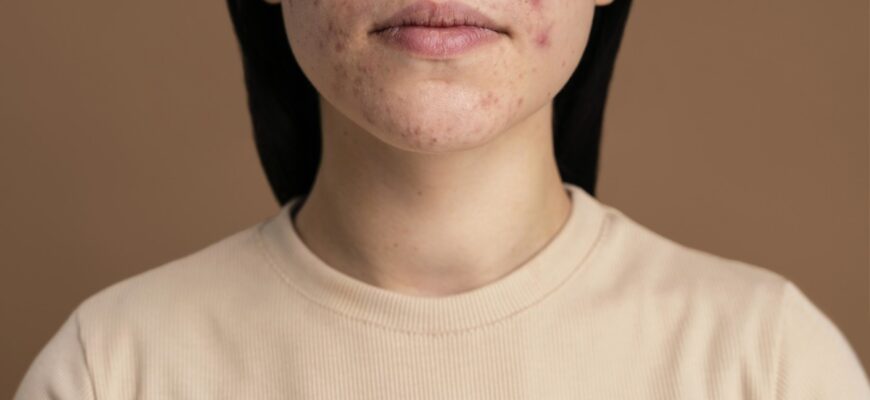 Демодекоз: розуміння причин, симптомів та методів лікування