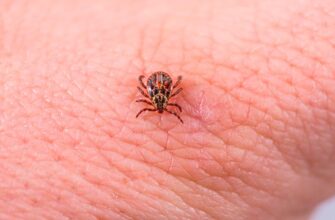 Хвороба Лайма: Симптоми, Діагностика та Способи Лікування