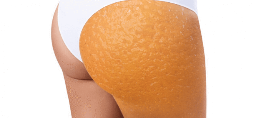 Целюліт: що це таке, причини виникнення та методи боротьби