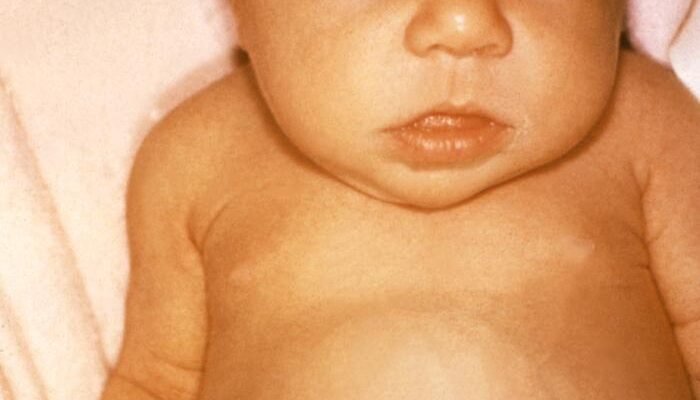 Гіпотиреоз: причини, симптоми та ефективні методи лікування захворювання