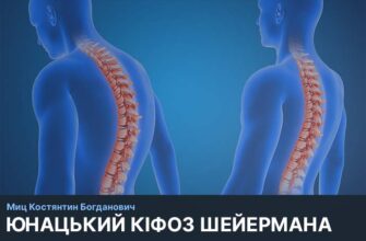 Що таке кіфоз: причини, симптоми та можливості лікування спини