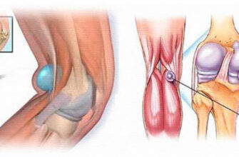 Що таке кіста Бейкера: симптоми, причини й методи лікування