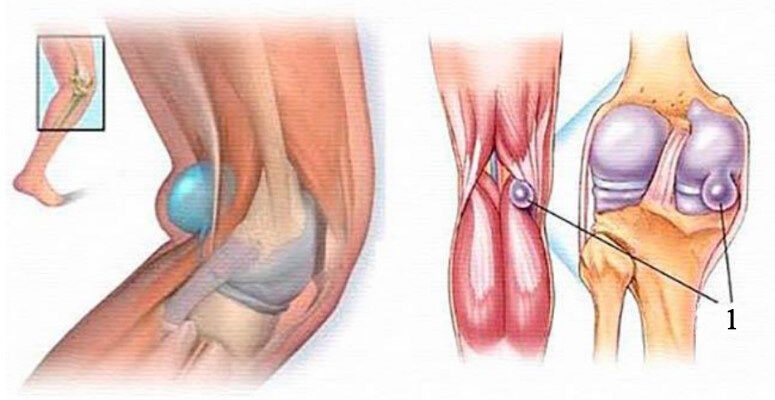 Що таке кіста Бейкера: симптоми, причини й методи лікування