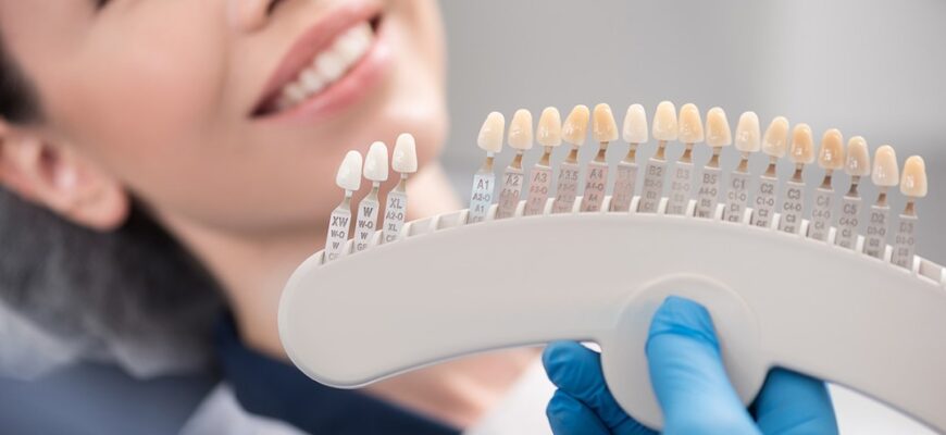 Керамічні та композитні вініри: відмінності та поради щодо вибору