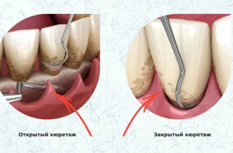 Що таке пародонтит: причини захворювання, симптоми та лікування