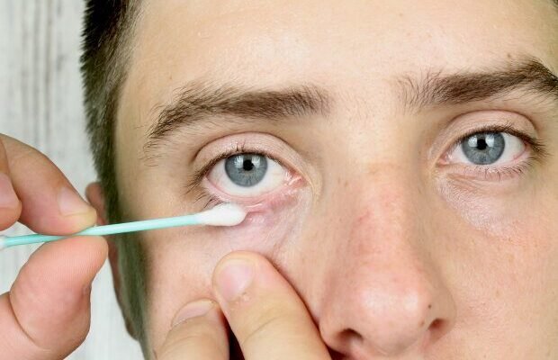 Що таке ячмінь на оці: причини, симптоми та методи лікування