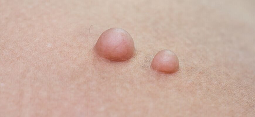 Ліпома: що це таке, як розпізнати та фото приклади утворень Ліпома: що це таке, як розпізнати та фото приклади утворень